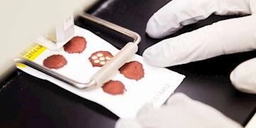 Resultat af blodprøven